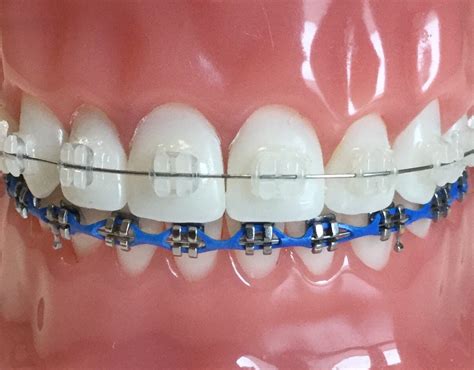 metal braces & brackets|traditional metal braces vs ceramic.